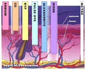 Types Of Lasers For Laser Hair Removal